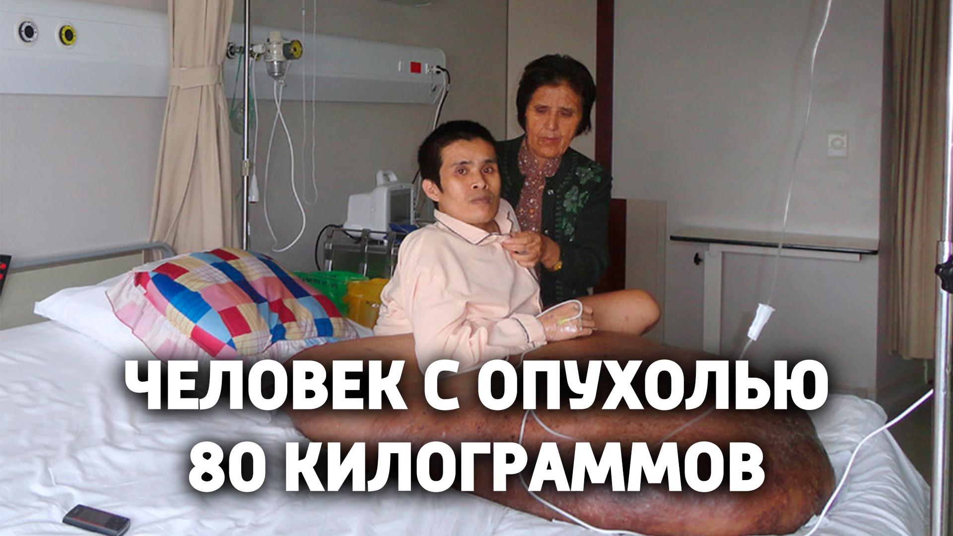 Человек с опухолью 80 килограммов (chelovek-s-opuholju-80-kilogrammov) Документальный фильм
