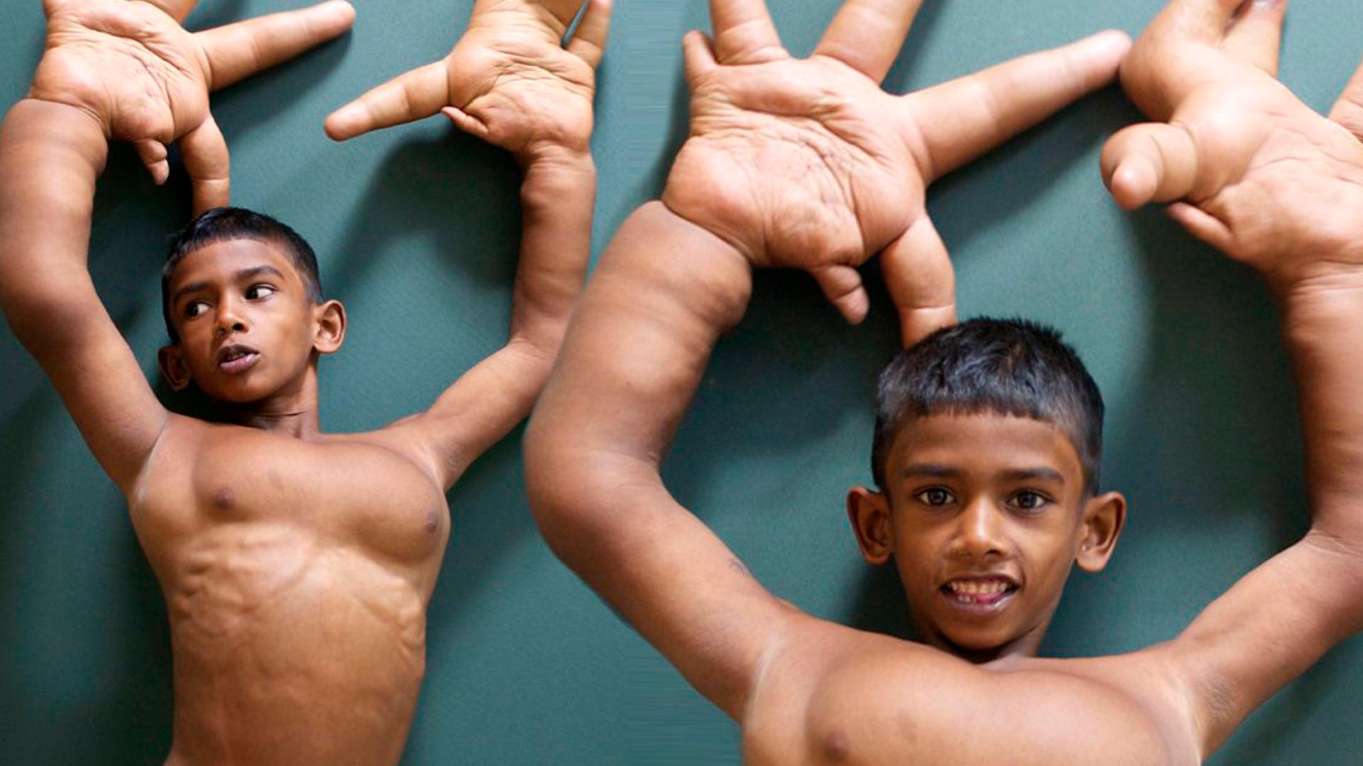 Мальчик с огромными руками (malchik-s-ogromnymi-rukami) Документальный фильм