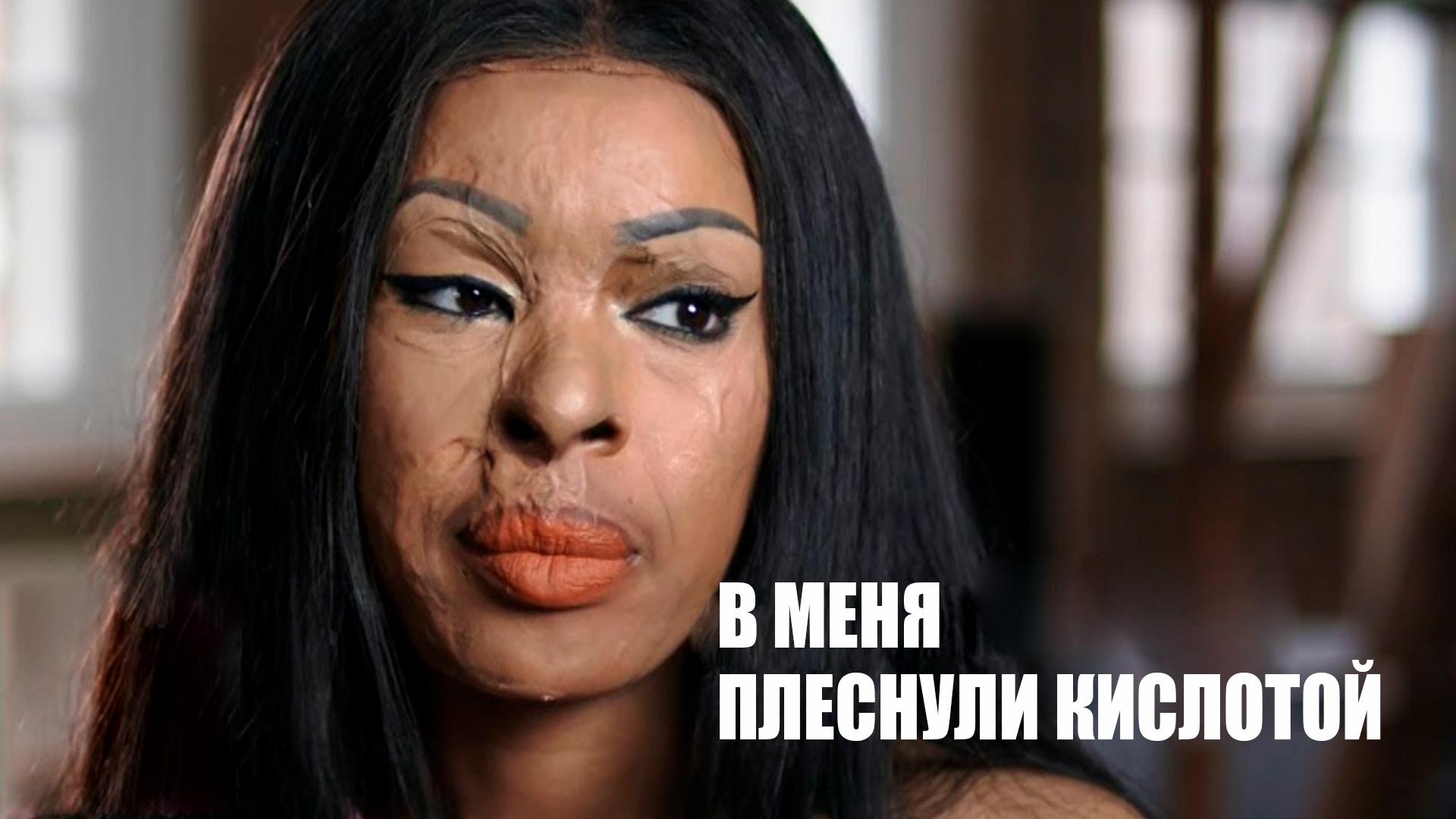 В меня плеснули кислотой (v-menja-plesnuli-kislotoj) Документальный фильм