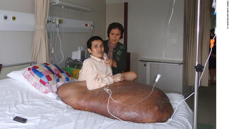 Постер The Man With The 200lb Tumour